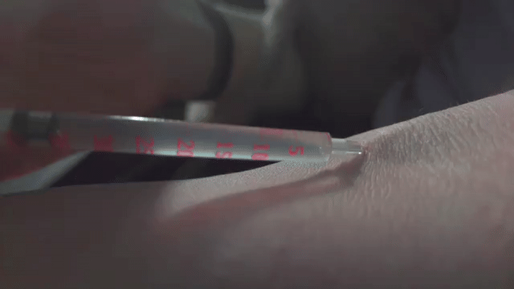 Blood plume from successful venipuncture